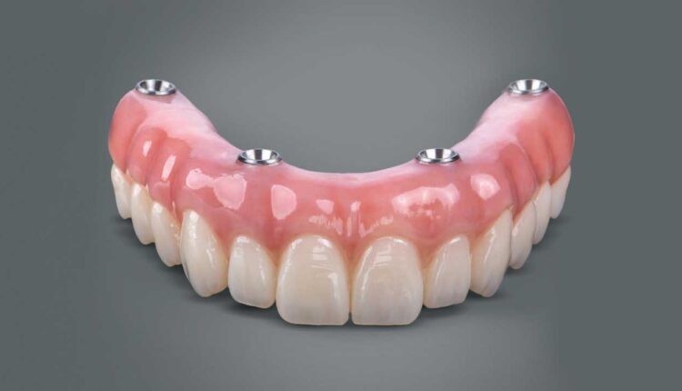 Can You Eat Normally with All-On-4 Dental Implants? | Buzzy