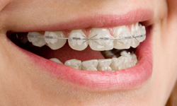 bull mountain orthodontics