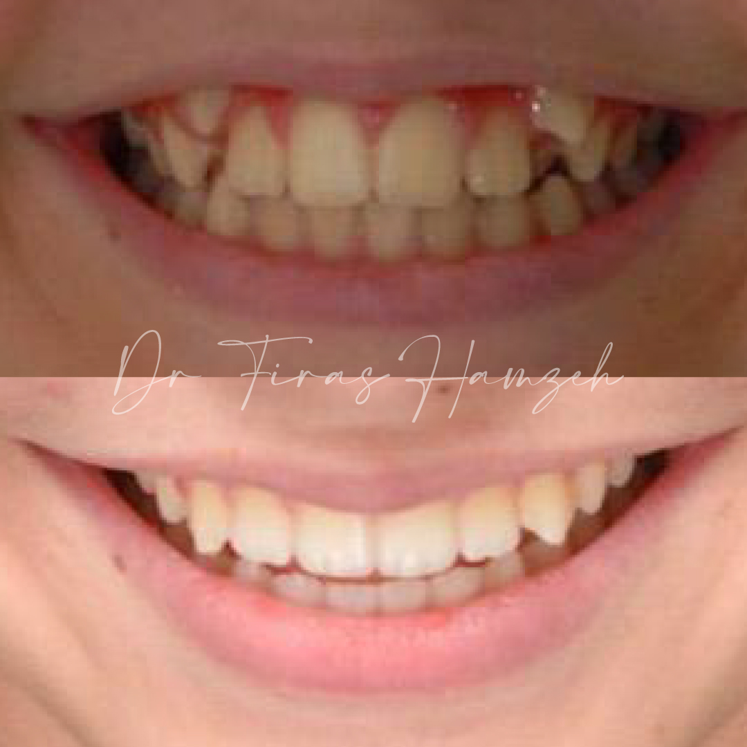 Spark Clear Aligners Treatment, Invisible Braces Cost in Dubai