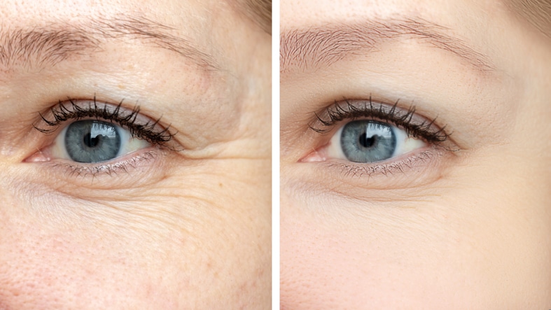 How Botox Works: The Anti-Aging Secret for Forehead, Crow’s Feet & More - Press Release Submission Sites Free, Free Instant Approval Guest Posting Sites